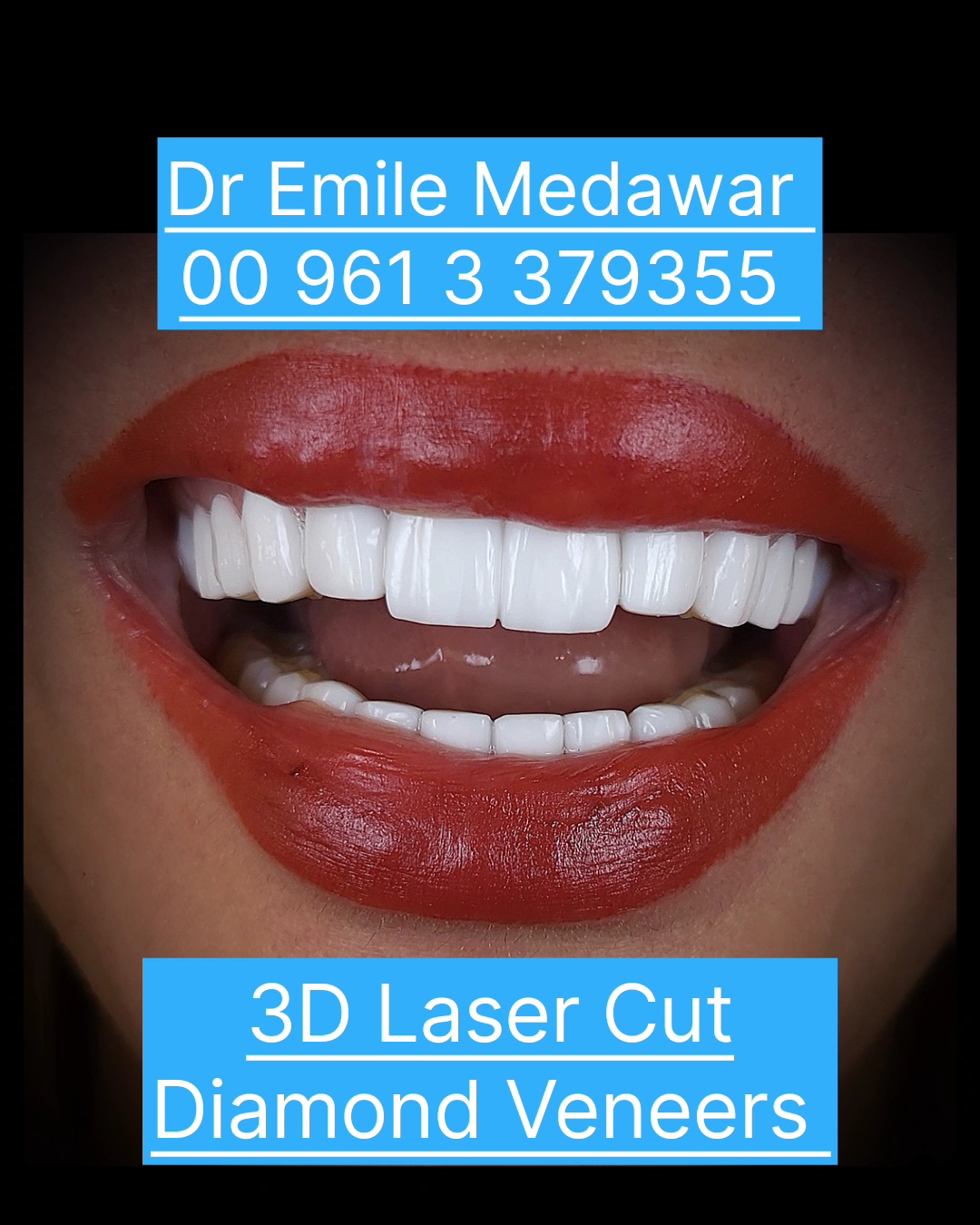 Thin transparent veneers by Dr Emile Medawar Lebanon