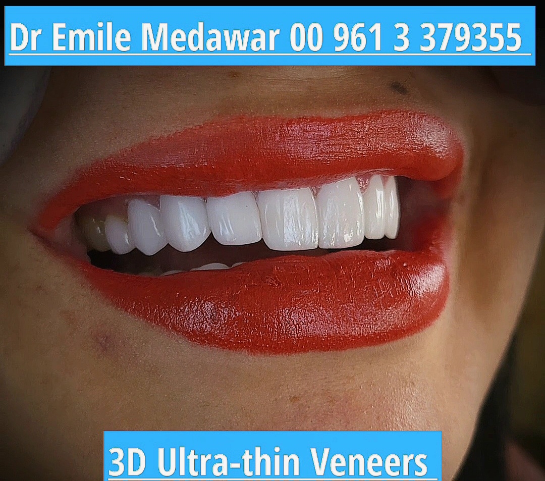 Natural looking no drilling veneers in Lebanon