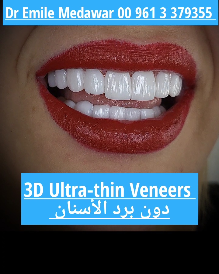 Transparent ultra thin dental veneers cosmetic dentistry