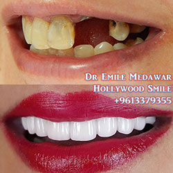 direct veneers