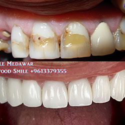 dental implants cost lebanon