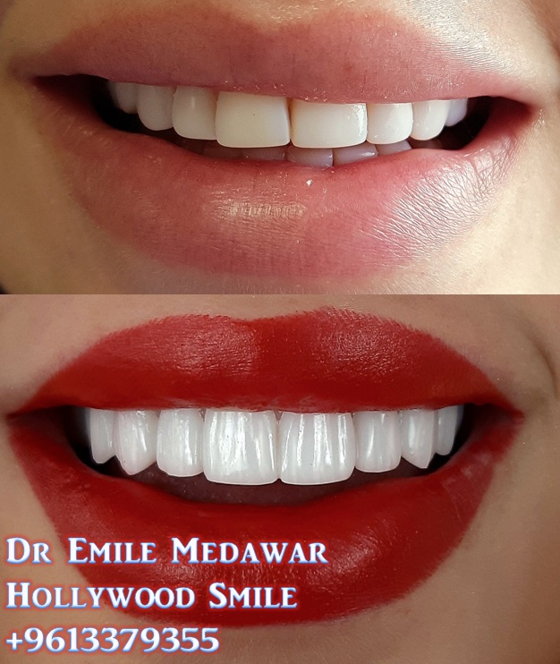 veneers lebanon