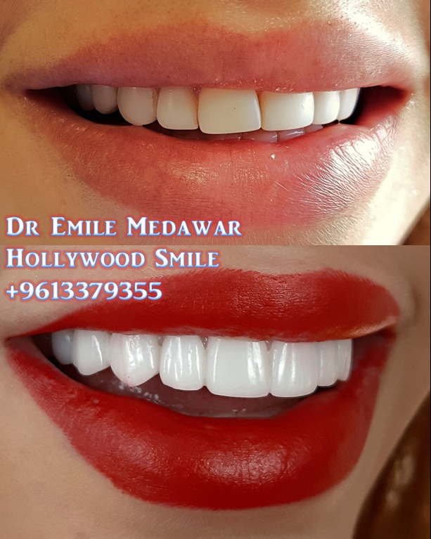 veneers lebanon beirut